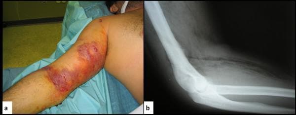 This composite educational material displays clinical and radiological findings of gas gangrene (clostridial myonecrosis) in the upper limb of a patient with a history of intravenous drug use. Figure (a) is a clinical photograph of the right arm showing severe localized edema, circumferential erythema, and large, dusky, hemorrhagic bullae (blistering) across the bicep and antecubital regions. Areas of purple-to-black skin discoloration suggest impending tissue necrosis. Figure (b) is a lateral X-ray of the same limb, demonstrating the pathognomonic sign of gas gangrene: extensive subcutaneous emphysema. This is characterized by radiolucent (dark) gas pockets and streaks dissecting through the soft tissue planes and muscle compartments, indicating gas production by anaerobic organisms such as Clostridium perfringens. The image serves to teach the correlation between clinical signs of rapidly progressing necrotizing soft tissue infection (crepitus, bullae, edema) and the critical radiographic finding of soft tissue gas.