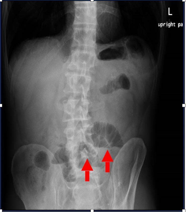 This diagnostic image is an upright posterior-anterior (PA) abdominal radiograph demonstrating signs of an evolving small bowel obstruction. The X-ray shows multiple dilated loops of small bowel in the mid and lower abdominal regions, identified by their radiolucent gas-filled appearance and central distribution. Red arrows specifically highlight dilated loops in the lower quadrants. The valvulae conniventes (plicae circulares) are visible within these segments, distinguishing them from large bowel. Bony landmarks including the lumbar spine and pelvic girdle appear intact and in normal alignment. Soft tissue shadows of solid organs are present but partially obscured by the increased bowel gas. This imaging is clinically significant for evaluating acute abdominal pain and mechanical obstruction, providing a visual baseline before further cross-sectional imaging (CT scan) or surgical intervention.