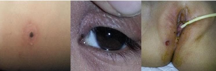 This composite of three clinical photographs displays the characteristic eschar of scrub typhus (Orientia tsutsugamushi) across different anatomical sites. The leftmost image shows a classic, well-circumscribed, necrotic eschar with a dark black central crust surrounded by an erythematous halo and slight edema. The middle image illustrates an eschar located on the inner canthus/eyelid region, appearing as a smaller dark-pigmented lesion. The rightmost image depicts a similar necrotic lesion in the perianal/groin region, accompanied by adjacent skin erythema and a medical catheter in situ. These lesions represent the site of a larval mite (chigger) bite and are pathognomonic clinical markers for rickettsial diseases like scrub typhus. The images emphasize the importance of thorough skin examination in febrile patients, particularly in skin folds and obscured areas where these diagnostic lesions are frequently found.