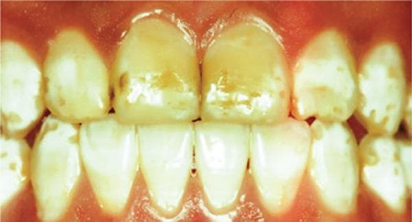 This intraoral clinical photograph displays the anterior dentition of a patient with severe dental fluorosis. The visual presentation is characterized by widespread enamel hypoplasia and significant intrinsic discoloration. The maxillary and mandibular teeth exhibit a loss of normal translucency, appearing opaque or chalky-white with prominent mottled patterns. Focal areas of moderate to dark brown extrinsic staining are visible, particularly on the labial surfaces of the central and lateral incisors. The enamel surface integrity is compromised, showing evidence of pitting, irregularities, and a matte texture rather than a healthy luster. The distribution is generalized across the visible arcade but most pronounced on the maxillary central incisors. This image serves as an educational example of advanced enamel defects caused by excessive fluoride ingestion during tooth development, categorized under the Dean's Index as severe, often requiring invasive restorative treatment.