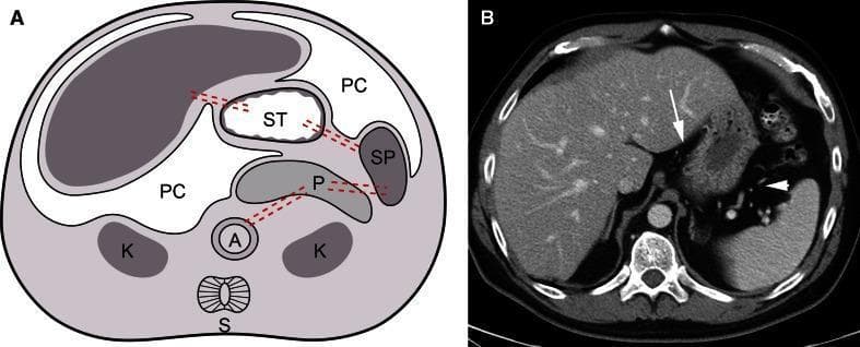 This educational image pairs an anatomical diagram with a corresponding axial contrast-enhanced CT scan of the upper abdomen to illustrate peritoneal anatomy and abdominal ligaments. Part A is a developmental schematic showing the relationships between the liver (L), stomach (ST), spleen (SP), and pancreas (P) within the peritoneal cavity (PC) and subperitoneal space. It identifies the ventral and dorsal mesenteries, including the gastrohepatic and gastrosplenic ligaments. Part B is an axial CT scan that correlates these findings in a clinical setting. The gastrohepatic ligament is indicated by a white arrow, appearing as a soft-tissue density band between the left lobe of the liver and the lesser curvature of the stomach, containing the left gastric artery. A white arrowhead identifies the gastrosplenic ligament, which connects the greater curvature of the stomach to the splenic hilum and contains the short gastric vessels. Visible organs include the liver, stomach, spleen, and spine, providing a clear demonstration of how subperitoneal ligaments serve as conduits for neurovascular structures and potential pathways for disease spread.