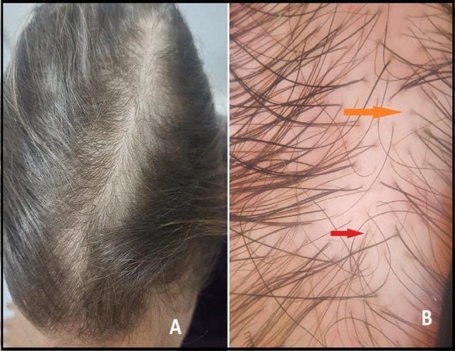 This composite educational figure illustrates the clinical and dermoscopic features of female pattern hair loss, specifically androgenetic alopecia. Image A is a clinical photograph of a 32-year-old female scalp showing a diffuse reduction in hair density. The thinning is most prominent across the vertex and mid-frontal regions, resulting in a widened central part and increased visibility of the underlying scalp. Image B is a high-magnification dermoscopy image of the same patient, highlighting diagnostic follicular signs. It demonstrates significant hair shaft diameter diversity (anisotrichosis), characterized by the coexistence of thick terminal hairs and thin vellus-like hairs. A red arrow points to a fine, non-pigmented vellus hair. An orange arrow indicates the 'peripilar sign,' which manifests as brown-gray perifollicular hyperpigmentation surrounding the hair shaft exit point. These visual markers are essential for distinguishing pattern alopecia from other forms of hair loss, such as telogen effluvium, in a clinical dermatology setting.