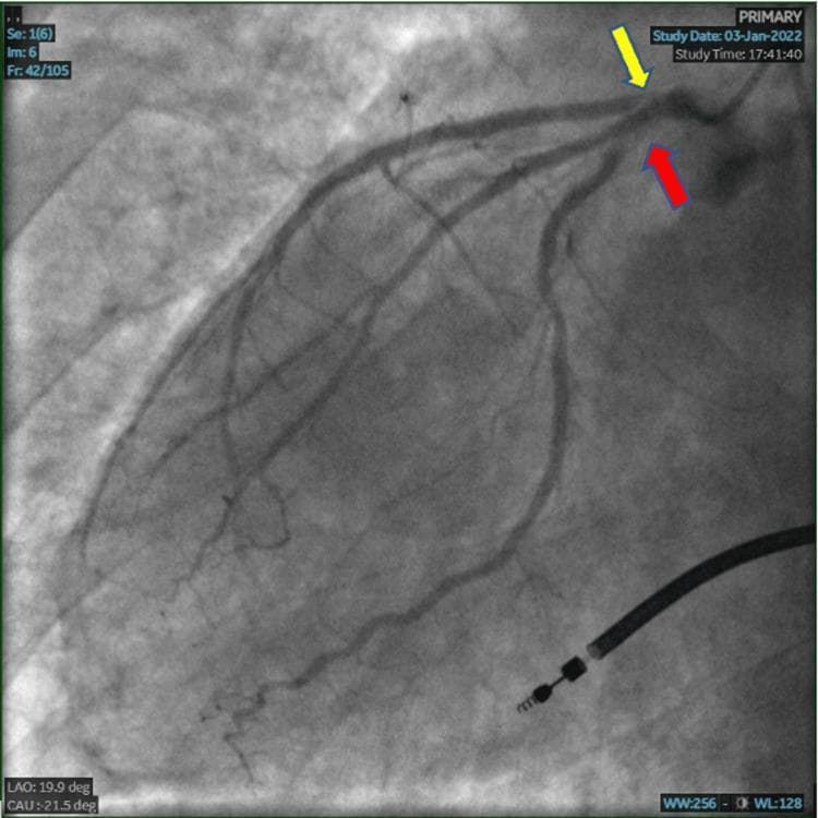 A coronary angiogram frame in the Left Anterior Oblique (LAO) caudal view, visualizing the left coronary system. The image demonstrates multi-vessel obstructive coronary artery disease. A yellow arrow points to the ostium-to-proximal segment of the Left Anterior Descending (LAD) artery, which shows severe narrowing consistent with 99% stenosis. A red arrow identifies the ostium-to-proximal segment of the Left Circumflex (LCx) artery, exhibiting high-grade 90% stenosis. The radiopaque contrast medium outlines the remaining patent lumen of the coronary vasculature, highlighting the critical luminal reduction in these major epicardial vessels. This diagnostic imaging is characteristic of an evaluation for ischemic heart disease or an acute coronary syndrome (ACS) event. The anatomical detail is optimized for interventional cardiology education, focusing on lesion localization and stenosis severity assessment.