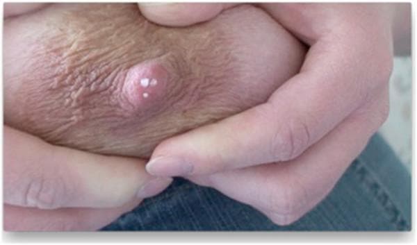 This clinical photograph shows a close-up view of the nipple-areola complex (NAC) during manual milk expression. The central focus is the nipple, a raised pinkish papilla mammaria, which exhibits several small, discrete white droplets of breast milk at the ductal orifices. The surrounding areola mammae displays a light tan or pinkish pigmentation with a textured, wrinkled surface marked by skin folds and creases. Fingers are visible at the upper and lower margins of the image, demonstrating the technique of manual compression to elicit milk flow. The image serves as an educational tool for identifying the functional anatomy of the mammary gland, specifically the location and distribution of milk ducts that transport milk to the surface during lactation. It illustrates clinical signs associated with breastfeeding and the physiological process of lactation in a female patient.