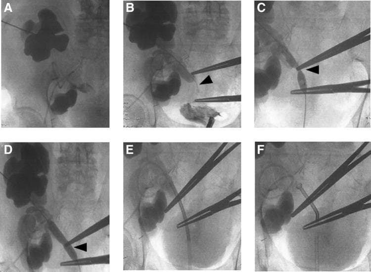 This composite of fluoroscopic images (A-F) illustrates an antegrade pyelogram and the interventional management of a ureteral stenosis in a 67-year-old patient with a double renal graft. Panel A demonstrates severe pelvicalyceal dilation (hydronephrosis) of the superior renal graft following percutaneous opacification. Panel B identifies the site of severe ureteral stenosis (arrowhead) at the level of the common iliac artery, with associated dilation of both the renal pelvis and proximal ureter. Panel C captures the use of a high-pressure balloon dilator over a 0.035-inch guidewire to treat the stricture. Panel D confirms the immediate post-dilation result, showing a wider ureteral lumen (arrowhead). Panel E shows the retrograde placement of an access sheath over the treated segment. Finally, Panel F visualizes the successful deployment and thermal expansion of a Memokath® 051 thermo-expandable metal stent, demonstrating restored ureteral patency. The series highlights critical steps in urological intervention, including nephrostomy access, balloon dilatation, and permanent stenting for obstructive uropathy in a complex transplant anatomy.