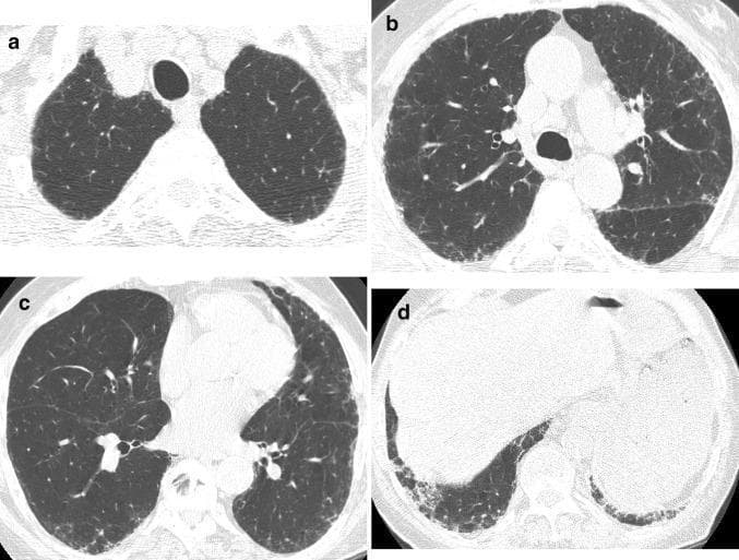 High-resolution computed tomography (HRCT) of the chest consisting of four axial slices (a–d) demonstrating interstitial lung disease. The images show a distribution of pulmonary fibrosis that is characteristically peripheral and subpleural, with a clear basilar predominance (visible in lower slices c and d). Key diagnostic features include fine reticulation (a network of linear opacities), traction bronchiectasis, and traction bronchiolectasis, representing irregular dilation of the airways due to surrounding parenchymal scarring. Notably, there is an absence of cystic honeycombing. This constellation of findings is most consistent with a 'possible Usual Interstitial Pneumonia (UIP)' pattern. Such imaging is critical in the evaluation of chronic fibrosing interstitial pneumonias, including idiopathic pulmonary fibrosis (IPF) and hypersensitivity pneumonitis, where the presence or absence of specific features like honeycombing helps determine the diagnostic certainty of the UIP pattern.