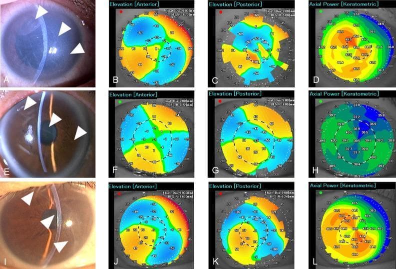 This composite ophthalmological figure displays clinical and diagnostic imaging from three cases of forceps-induced corneal injury, illustrating the relationship between Descemet membrane (DM) breaks and corneal astigmatism.
Column 1 (A, E, I) consists of slit-lamp photographs demonstrating linear DM breaks highlighted by white arrowheads. These breaks exhibit varying orientations: oblique in Case 1, horizontal in Case 2, and vertical in Case 3.
Columns 2 and 3 (B, C, F, G, J, K) show corneal topography elevation maps for both anterior and posterior surfaces. These maps reveal localized blue-coded regions indicating posterior corneal shifts that align precisely with the location and orientation of the DM breaks seen in the slit-lamp images.
Column 4 (D, H, L) presents axial keratometric power maps showing significant corneal astigmatism. The steep and flat axes of astigmatism correlate with the physical orientation of the DM ruptures, highlighting how birth trauma-related DM breaks lead to permanent high-degree irregular astigmatism and potentially amblyopia. The data underscores the role of posterior corneal surface changes in driving total corneal aberrations in these patients.