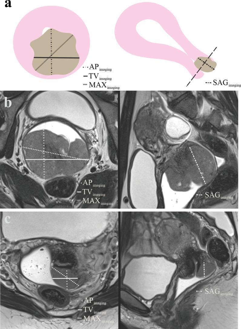 This educational image details the radiological assessment and measurement protocols for cervical cancer using MRI.