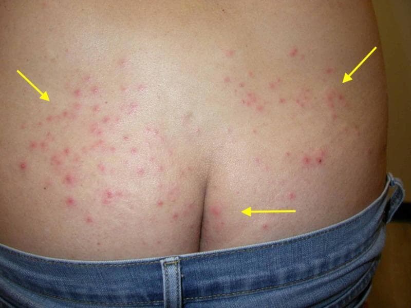 This clinical photograph shows a posterior view of the lower back and upper buttocks of a patient, demonstrating a widespread inflammatory skin eruption. The primary lesions are small, erythematous papules and pustules, some of which exhibit a central punctum or follicular orientation. The distribution is bilateral but asymmetrical, with significant clustering along the lower back and superior gluteal regions. Yellow arrows highlight representative clusters of these lesions. The distribution pattern corresponds to areas typically occluded by clothing, such as swimwear or the waistband of the denim jeans visible in the frame. The morphology and clinical presentation are highly suggestive of folliculitis, specifically 'hot tub folliculitis' (Pseudomonas folliculitis) given the context of occlusion and characteristic inflammatory papulopustular appearance. This visual serves as an educational example of bacterial folliculitis and the importance of lesion distribution in dermatological diagnosis.