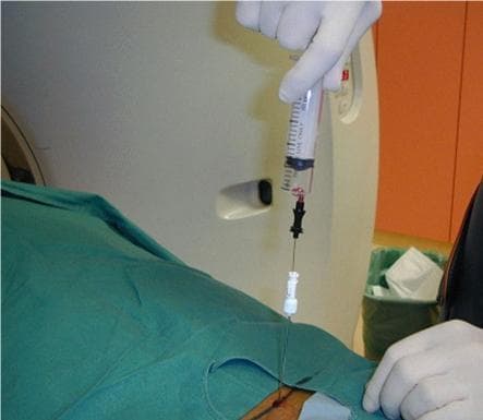 This clinical photograph illustrates the coaxial needle technique used during a CT-guided percutaneous biopsy of the lumbar spine. A patient is positioned on a CT table, covered with a green sterile surgical drape featuring a small central aperture for the procedure site. The primary visual focus is the needle assembly: a larger-bore Ostycut trephine needle, identified by its white hub, serves as an outer cannula. Inserted through this is a finer-gauge Chiba aspiration needle, distinguished by its black hub and an attached syringe held by a gloved operator. This coaxial arrangement allows for multiple tissue samples to be obtained through a single puncture tract, minimizing trauma. The procedure is performed in an interventional radiology suite, with the CT gantry visible in the background. The setup demonstrates standard sterile technique and the use of specialized interventional equipment for spinal pathology investigation.