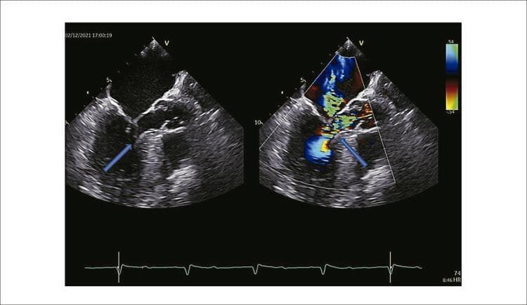 This diagnostic image displays a side-by-side comparison of intraprocedural transesophageal echocardiography (TEE) at approximately 150 degrees. The left panel is a grayscale B-mode image showing the mitral valve apparatus and left ventricular outflow tract (LVOT). An arrow highlights systolic anterior motion (SAM) of the mitral valve, where the anterior leaflet moves towards the hypertrophied interventricular septum. The right panel incorporates color Doppler imaging, revealing significant flow acceleration and turbulence (mosaic pattern/aliasing) at the point of obstruction in the LVOT, also indicated by an arrow. This turbulent jet is characteristic of dynamic outflow obstruction often seen in hypertrophic obstructive cardiomyopathy (HOCM). Additionally, the Doppler image suggests associated mitral regurgitation due to valve malcoaptation. An ECG tracing is visible at the bottom for cardiac cycle synchronization. This visual is used to identify the precise location of flow acceleration and to quantify the severity of subvalvular obstruction and regurgitation during septal ablation procedures.