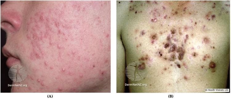 This clinical photograph set provides a comparative view of varying severities of acne. Image (A) displays Acne vulgaris on the facial region, specifically the cheek and jawline. It is characterized by a polymorphic eruption consisting of closed comedones (whiteheads), erythematous inflammatory papules, and small pustules distributed across a background of diffuse facial erythema. Image (B) demonstrates a more severe manifestation known as nodulocystic acne on the chest. This presentation features deeper, larger inflammatory lesions including firm nodules and fluctuant cysts. Significant post-inflammatory hyperpigmentation (PIH) and crusting are visible, with lesions often clustering to form larger inflammatory complexes. The comparison highlights the progression from superficial inflammatory acne to deep, scarring-prone nodulocystic disease. These images are intended for medical education regarding dermatological classification, lesion morphology identification, and clinical staging of acne severity.