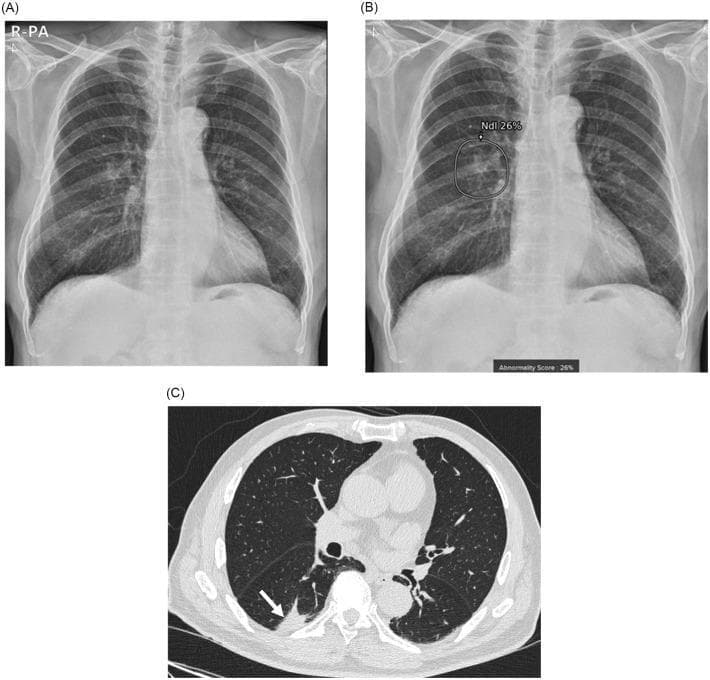 A multi-panel clinical diagnostic set showing a lung adenocarcinoma in a 79-year-old male. Image (A) is a posterior-anterior (PA) chest radiograph showing a subtle, ill-defined opacity in the right lower lung field, partially obscured by overlying pulmonary vasculature. Image (B) displays the same radiograph with an artificial intelligence (AI) lesion detection overlay; a circular region of interest (ROI) highlights the lesion, accompanied by a quantitative 'Abnormality Score' and a confidence label 'Ndl 26%'. Image (C) is an axial chest computed tomography (CT) scan in lung window settings, providing high-resolution anatomical detail. It clearly delineates an irregular solid mass (indicated by a white arrow) located in the posterior subpleural space of the right lower lobe's superior segment. The set illustrates the comparative diagnostic utility between standard radiography, AI-assisted screening, and definitive CT imaging for identifying pulmonary malignancies like stage IA3 adenocarcinoma.