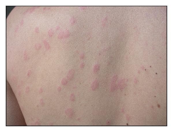 This clinical photograph displays a human patient's back presenting with multiple pink-to-red edematous lesions characteristic of urticaria (hives). The lesions are primarily wheals of varying sizes, ranging from small papules to larger, confluent plaques. A distinct morphological feature of these lesions is their annular or targetoid appearance, characterized by raised, erythematous margins with central pallor. The distribution is scattered and non-contiguous across the dorsal trunk, with clear skin visible between the affected areas. There are no signs of secondary changes such as scaling or ulceration, though the presentation is typical for transient inflammatory skin reactions. The image serves as an educational example of common dermatological manifestations of urticaria, illustrating the classical morphology of wheals and flares used in clinical diagnosis and primary care dermatology.