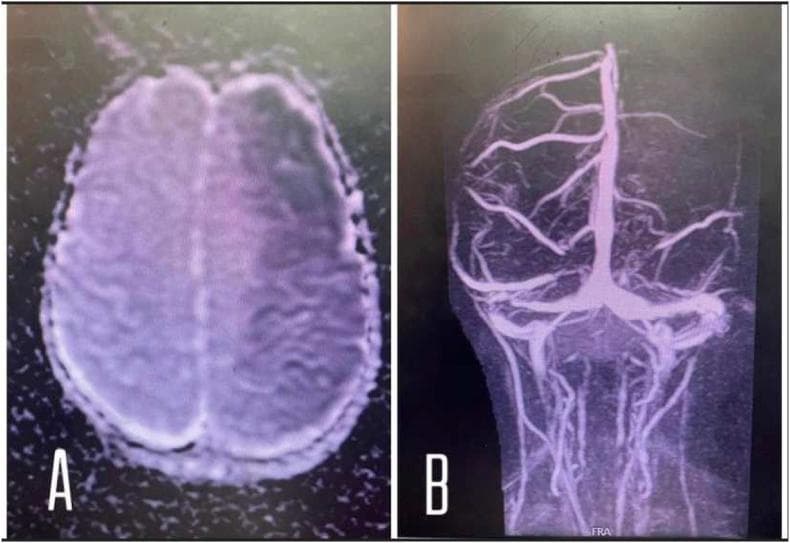 This dual-panel diagnostic image presents neuroradiological findings of an acute ischemic stroke. Figure A is an axial brain MRI (DWI/ADC sequence or T1-weighted equivalent) showing a large, ill-defined area of vague hypodensity in the left cerebral hemisphere. The lesion corresponds to the vascular territory of the left middle cerebral artery (MCA), indicating extensive subacute infarction. Notably, there is an absence of significant midline shift, mass effect, or hyperdense hemorrhagic transformation. Figure B is a Magnetic Resonance Angiography (MRA) displaying the intracranial vasculature. It demonstrates a complete occlusion and abrupt termination of the left middle cerebral artery, contrasting with the patent right MCA and normal basilar/vertebral artery anatomy. This visual pair illustrates the correlation between clinical vessel occlusion (MRA) and resulting parenchymal tissue damage (MRI) in the context of neurovascular pathology.
