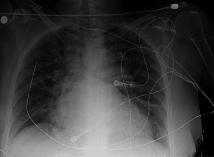 This anterior-posterior (AP) chest X-ray illustrates a case of acute pulmonary edema and cardiomegaly. The primary findings include diffuse, bilateral alveolar opacities and patchy infiltrates that exhibit a predominantly perihilar 'bat-wing' distribution. These densities obscure normal vascular markings and contribute to a mottled, ground-glass appearance throughout the mid-to-lower lung zones. The cardiac silhouette is significantly enlarged, with a widened mediastinum and indistinct heart borders consistent with congestive heart failure. Multiple supportive medical devices are present: a right-sided central venous catheter with its tip at the level of the superior vena cava, several circular radiopaque ECG electrode markers with associated lead wires traversing the anterior chest, and a vertical enteric tube passing through the lower mediastinum. The costophrenic angles are partially blunted by overlying infiltrates or potential pleural effusion. This diagnostic image serves as a classic representation of cardiogenic pulmonary edema for clinical educational purposes.