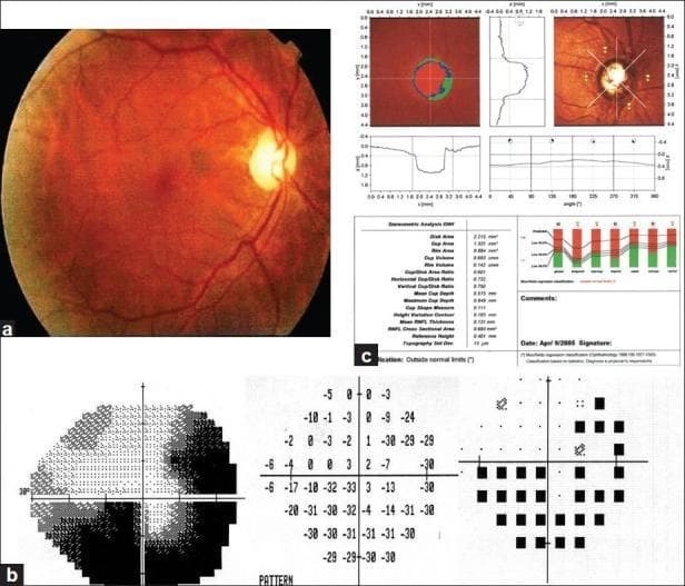 This composite ophthalmological diagnostic image illustrates clinical findings in Primary Open Angle Glaucoma (POAG). Panel A shows a color fundus photograph of the right eye with a prominent reddish-orange background and a centrally located optic disc exhibiting pathologic cupping, with a cup-to-disc ratio of 0.7. Panel B presents Automated Static Perimetry (visual field test) results, demonstrating a significant inferior altitudinal defect and a superior temporal arcuate scotoma, visualized through grayscale maps and numerical sensitivity data. Panel C displays Heidelberg Retina Tomograph (HRT) data, providing topographic analysis of the optic nerve head. The HRT report includes stereometric analysis, cross-sectional profiles of the optic cup, and a Moorfields regression classification indicating findings 'outside normal limits.' The educational focus is on the clinical correlation between anatomical optic nerve changes and functional visual field loss in glaucomatous neuropathy.