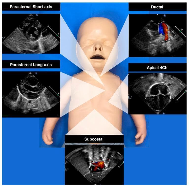Educational medical graphic illustrating standard Neonatologist-Performed Echocardiography (NPE) views using a central neonatal mannequin as a reference for transducer placement. The composite includes five labeled diagnostic ultrasound panels: 1) Parasternal Short-axis, providing a cross-sectional view of the ventricles; 2) Parasternal Long-axis, showing the longitudinal orientation of the left ventricle, right ventricle, and aortic outflow; 3) Ductal view, utilizing color Doppler to visualize blood flow through the ductus arteriosus (DA) with red and blue signals indicating directionality; 4) Apical 4-chamber (4Ch), showing the four cardiac chambers from the apex; and 5) Subcostal view, displaying color Doppler flow within the central heart structures. The diagram is designed for clinical training in neonatal cardiology, specifically for evaluating hemodynamic stability, cardiac anatomy, and patent ductus arteriosus (PDA) shunting patterns. Red and blue Doppler signals in the ductal and subcostal views facilitate the assessment of bidirectional or turbulent flow, critical for identifying shunts or 'steal phenomenon' in premature infants.