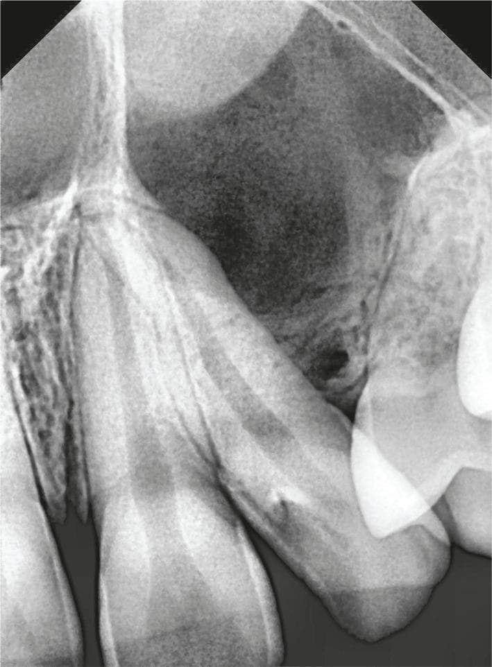 This intraoral periapical (IOPA) radiograph depicts the maxillary anterior and premolar region, specifically involving the left lateral incisor and first premolar. The primary finding is a large, ill-defined radiolucent lesion located between the roots of these teeth. The pressure from this lesion has caused significant distal and mesial deflection of the adjacent roots, increasing the inter-radicular space. Superior to this primary radiolucency, a dense, partial radiopacity is visible, suggesting the presence of an unerupted impacted tooth, possibly the maxillary canine. Additionally, a smaller, well-defined circular radiolucency is noted at the alveolar crest between the lateral incisor and first premolar. The overall radiographic presentation is highly suggestive of a pericoronal or cystic lesion, such as a dentigerous cyst, associated with an impacted tooth. The image illustrates key diagnostic features in oral and maxillofacial pathology, including root divergence and the characteristic radiolucency associated with odontogenic cysts in a pediatric or adolescent patient.