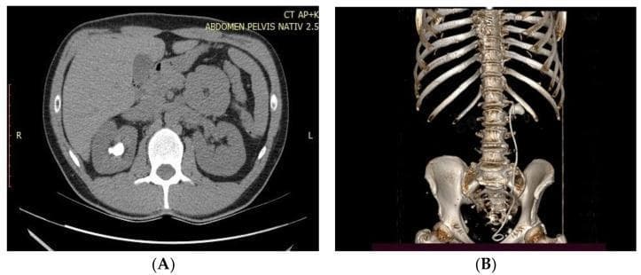 This composite educational resource features diagnostic imaging for nephrolithiasis. Image (A) is a non-contrast axial CT scan of the abdomen at the level of the kidneys. A high-density (radio-opaque), irregular calcification representing a large renal stone is clearly visible in the right kidney. The axial view demonstrates the posterior position of the kidneys relative to the liver and anterior abdominal organs, with the vertebral body centrally located. Image (B) shows a 3D volumetric reconstruction of the thoracolumbar spine and pelvis. It visualizes a double-J (DJ) ureteral stent in situ, extending from the right renal pelvis, following the anatomical course of the ureter anterior to the psoas muscle, and terminating in the bladder region. The reconstruction provides a clear view of the lower rib cage, lumbar vertebrae, and pelvic girdle, illustrating the spatial relationship between the urinary drainage system and the skeletal framework. These images are clinically relevant for teaching urological stone management and postoperative stent placement evaluation.