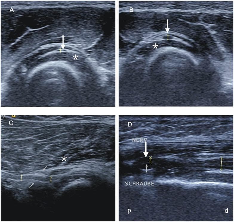 High-resolution sonographic diagnostic images illustrating radial nerve pathology. (A, B) Transverse ultrasound views compare the posterior interosseous nerve (PIN) within the supinator muscle (asterisk). Image A shows normal nerve morphology (arrow) on the healthy side, while Image B demonstrates significant hypoechoic swelling and increased cross-sectional area of the PIN on the affected side, indicating a proximal lesion. (C) Longitudinal ultrasound view shows the PIN with focal caliber change and swelling prior to its entry into the Arcade of Frohse (thin arrows) and as it passes through the supinator muscle (asterisk). (D) Longitudinal ultrasound of the distal upper arm shows the radial nerve (NERV) being compressed by a hyperechoic metallic osteosynthesis screw (SCHRAUBE), resulting in a visible focal indentation and nerve displacement (arrow). These images serve as educational materials for identifying nerve entrapment, post-surgical complications, and sonographic markers of peripheral neuropathy such as nerve edema and mechanical impingement.