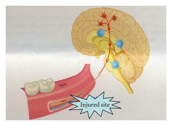 A medical illustration depicting the pathophysiology of nerve injury and central sensitization. The diagram shows a sagittal section of the human brain and a cross-section of the mandible. In the mandible, the inferior alveolar nerve is shown within the mandibular canal; a callout labeled 'Injured site' highlights a mechanical disruption (neurotmesis or axonotmesis) of the nerve fibers, while an adjacent vessel remains intact. A neural pathway is traced from this peripheral injury site, ascending through the trigeminal ganglion toward the central nervous system. Within the brainstem, midbrain, and thalamic regions, blue burst icons symbolize neuronal activation or modification along the second-order neuron pathway. The pathway terminates in the somatosensory cortex, marked by red starburst symbols and radiating lines, illustrating cortical reorganization or the perception of neuropathic pain. The illustration serves as an educational tool for understanding the retrograde effects of peripheral nerve trauma on central processing and chronic pain development.