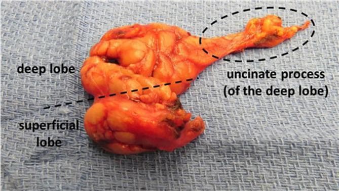 Clinical photograph of a gross submandibular gland resection specimen, demonstrating its complex lobular anatomy. The specimen is displayed on a blue surgical drape and is annotated to show the division between the larger superficial lobe and the smaller deep lobe, separated by a dashed line representing the anatomical plane typically defined by the mylohyoid muscle. Extending anteriorly from the deep lobe is the uncinate process, highlighted within a dotted oval. This process appears as an elongated, thinner extension of parenchymal tissue that normally wraps around the posterior border of the mylohyoid muscle to enter the sublingual space. The glandular tissue exhibits a characteristic yellowish-orange, lobulated appearance. This image serves as an educational reference for head and neck surgery, specifically illustrating the 'uncinate process' which can be mistaken for sublingual gland tissue or involved in pathologies like ranulas. The specimen represents an extended resection that includes both the deep lobe and Wharton's duct.