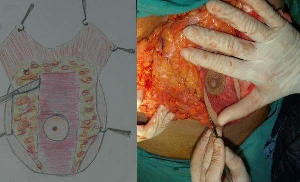 This composite educational resource consists of a medical diagram and an intraoperative clinical photograph illustrating a reduction mammaplasty technique focusing on the resection of medial and lateral tissues while preserving a central pedicle. The anatomical diagram (left) provides a schematic of the breast, highlighting a central rectangular region (pink) containing the nipple-areola complex (NAC) to be preserved as a posterior pedicle, surrounded by peripheral areas designated for resection. The intraoperative photograph (right) displays the surgical application of this technique. It depicts the surgeon's gloved hands using a scalpel to perform a precise resection of the lateral and medial breast parenchyma. The exposed tissue exhibits a characteristic yellow hue indicative of adipose tissue mixed with reddish glandular tissue and superficial vasculature. The central vertical pedicle is clearly visible, appearing more dense and pinkish-red compared to the disrupted peripheral tissues. This visual material is intended for plastic surgery education, demonstrating the creation of a U-shaped central pedicle to maintain neurovascular integrity and lactational function during breast reduction.