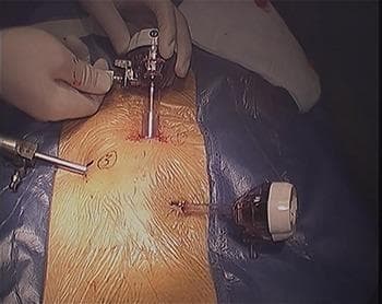 A clinical photograph of the surgical field during a Totally Extraperitoneal (TEP) inguinal hernia repair. The image displays the abdominal region prepped with antiseptic and surrounded by blue sterile drapes. Three laparoscopic cannulas (trocars) are successfully inserted into the preperitoneal space in a triangular configuration. The primary 12-mm observation cannula is positioned superiorly at the subumbilical midline, held by a surgeon's gloved hand. Two smaller operative cannulas are positioned inferiorly and laterally to the midline; the left-sided cannula insertion point is marked with a numeral '3' on the skin. Small, clean transverse incisions are visible at the entry points. This stage of the procedure demonstrates the portal placement necessary for establishing the preperitoneal working space and subsequent endoscopic visualization of the internal inguinal ring for mesh placement or suturing.