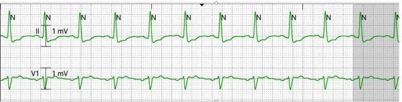 This diagnostic image shows a two-lead electrocardiogram (ECG) telemetry strip displayed on a standard grid background. The top tracing is labeled Lead II and the bottom tracing is labeled Lead V1, each with a 1 mV calibration marker. The tracings demonstrate a normal sinus rhythm with regular P waves, narrow QRS complexes, and upright T waves. Each QRS complex is automatically annotated with the letter 'N', indicating a recognized normal beat by the telemetry system. Lead II exhibits tall R waves, while Lead V1 shows a predominantly negative S-wave morphology with a small initial R wave, consistent with standard precordial lead placement. This strip serves as a clinical illustration of successful restoration of normal sinus rhythm following an intervention for electrical storm, specifically after an ultrasound-guided left stellate ganglion block. The rhythm is stable, with consistent PR and RR intervals throughout the captured segment.