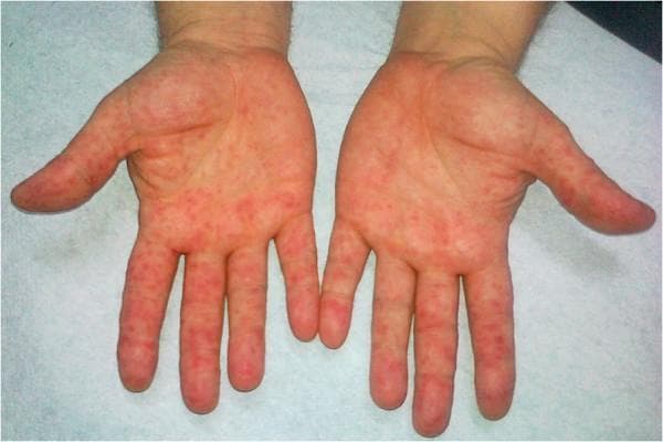 This clinical photograph displays the bilateral palmar surfaces of an adult's hands, demonstrating a widespread, symmetrical vesicular rash. The dermatological findings include numerous small, discrete, erythematous macules and papulovesicles. The lesions are distributed across the entire palmar aspect, extending onto the volar surfaces of the fingers and thumbs. The skin exhibits generalized erythema and mild swelling, particularly around the concentrated areas of vesicles. The morphology and characteristic distribution on the palms are hallmark clinical signs of Hand, Foot, and Mouth Disease (HFMD), typically caused by Coxsackievirus A16 or Enterovirus 71. This visual serves as a primary educational example for diagnosing viral exanthems in a clinical setting, highlighting the transition from macular redness to distinct vesicular lesions on acral surfaces.
