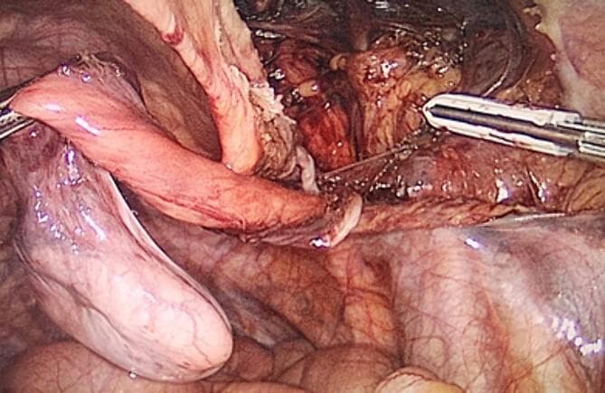 This laparoscopic photograph provides an intra-abdominal view of a surgical procedure for an undescended testis (cryptorchidism) associated with an inguinal hernia. The image prominently features a dissected, atrophic testicle, which appears as a pale, bulbous, and elongated structure being manipulated by surgical graspers. Attached to and surrounding the testis is a thin, glistening, and translucent membrane representing the hernia sac. Key anatomical structures visible include the spermatic cord and associated testicular vasculature, characterized by a network of fine reddish vessels. The operative field shows the inguinal canal region where the testis has been retracted into the peritoneal cavity for orchidectomy. The background depicts the surrounding peritoneal tissue and pelvic floor anatomy. This image illustrates a critical step in the laparoscopic management of adult cryptorchidism and inguinal hernioplasty (TAPP procedure), demonstrating the visual relationship between the ectopic gonad, its vascular supply, and the peritoneal defect.