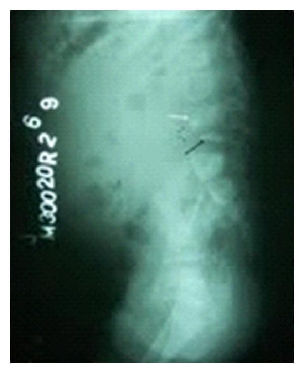 This diagnostic image is a lateral plain film X-ray of the lumbosacral spine. The radiograph reveals a significant focal kyphotic angulation, known as a gibbus deformity, centered at the L4-L5 vertebral level. A prominent wedge-shaped collapse of the L4 vertebral body is visible, indicating severe loss of anterior vertebral height and structural compromise. Additionally, radiopaque bony fragments are noted in the prevertebral space anterior to the L4 level, consistent with vertebral destruction or fragmentation. The visual findings are characteristic of advanced spinal pathology, such as Pott's disease (spinal tuberculosis), which typically manifests with vertebral body destruction, collapse, and resultant sharp angulation of the spinal column. The image demonstrates key educational markers of infectious or destructive spondylodiscitis, including vertebral wedging and secondary spinal curvature abnormalities.