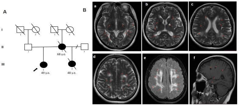 This composite educational image features a pedigree chart and neuroimaging findings consistent with Cerebral Autosomal Dominant Arteriopathy with Subcortical Infarcts and Leukoencephalopathy (CADASIL). Panel A presents a three-generation pedigree demonstrating an autosomal dominant inheritance pattern of a neurodegenerative condition. Panel B displays diagnostic brain MRI sequences, including T2-weighted axial sections (a-d), a FLAIR axial section (e), and a T1-weighted sagittal section (f). The imaging reveals extensive, bilateral, and often symmetrical white matter hyperintensities (WMH). Key findings include confluent hyperintensities in the periventricular and deep white matter, and multiple subcortical lacunar lesions marked by red arrows. Notable features include the involvement of the temporal lobes and external capsules, which are characteristic markers for CADASIL. The sagittal view demonstrates the vertical distribution of these lesions within the white matter. This visual is intended for clinical training in identifying hereditary small vessel diseases and understanding the correlation between genetic family history and characteristic radiological signatures of leukoencephalopathy.