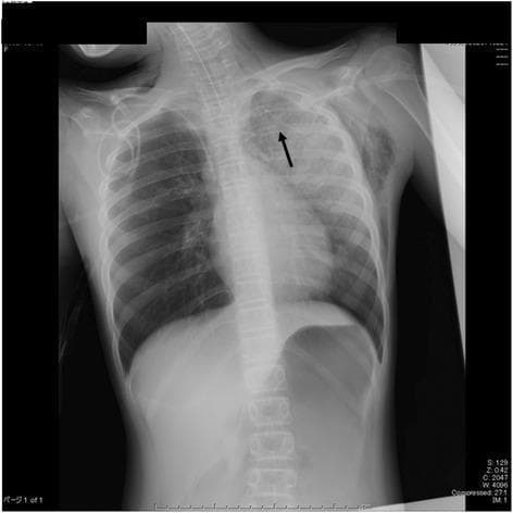 This diagnostic image is an anteroposterior (AP) chest X-ray illustrating the clinical management of a tension pneumothorax. The radiograph shows the thorax of a pediatric patient with an 18G intravenous cannula (indicated by a black arrow) inserted into the upper left lung field, specifically at the level of the second intercostal space in the mid-clavicular line. This device was utilized for emergent needle decompression. Significant radiographic findings include bilateral lung fields with marked hyperinflation of the left lung relative to the right, consistent with post-decompression status. The mediastinum appears centrally located, though evidence of previous tension can be inferred by the clinical context. Other visible features include a midline tracheal tube and gastric gas bubble. This image serves as an educational example of emergency procedural intervention for life-threatening respiratory distress and the visual confirmation of decompression device placement in a critical care setting.
