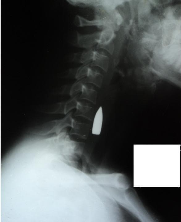 This lateral neck radiograph (X-ray) demonstrates a highly radiopaque, metallic foreign body, consistent with a bullet, lodged in the soft tissues of the neck. The object is situated anterior to the C6 and C7 cervical vertebrae. The cervical spine shows normal lordotic curvature and vertebral alignment without obvious fractures in the immediate vicinity of the projectile on this view. Anatomical landmarks visible include the cervical vertebrae (C1-C7), the mandible, the skull base, and the clavicle. The image illustrates a critical clinical scenario involving penetrating neck trauma. The dense, sharply defined margins of the object indicate a metallic composition typical of ballistics. Educational value centers on the radiographic identification of foreign bodies, assessment of vertebral integrity in trauma, and the spatial relationship between projectiles and vital structures such as the carotid sheath and airway.