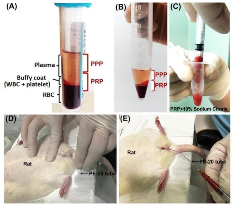 This composite figure illustrates the laboratory protocol for preparing and administering platelet-rich plasma (PRP) in a translational research model. Panel (A) shows a primary blood collection tube after initial centrifugation, demonstrating the separation of whole blood into three distinct layers: the straw-colored plasma at the top, a thin whitish buffy coat containing white blood cells (WBC) and platelets in the middle, and dense red blood cells (RBC) at the bottom. Panel (B) depicts a conical tube after secondary centrifugation, further partitioning the plasma into platelet-poor plasma (PPP) at the top and platelet-rich plasma (PRP) at the base. Panel (C) captures the mixture of PRP with sodium citrate, which serves to maintain the plasma in a liquid state for therapeutic use. Panels (D) and (E) demonstrate the clinical application phase, showing a rat under anesthesia where a PE-20 tube is inserted for intravesical (bladder) instillation of the prepared PRP/PPP mixture. This procedural sequence highlights the essential steps of centrifugation, fractionation, and targeted delivery for regenerative medicine studies.