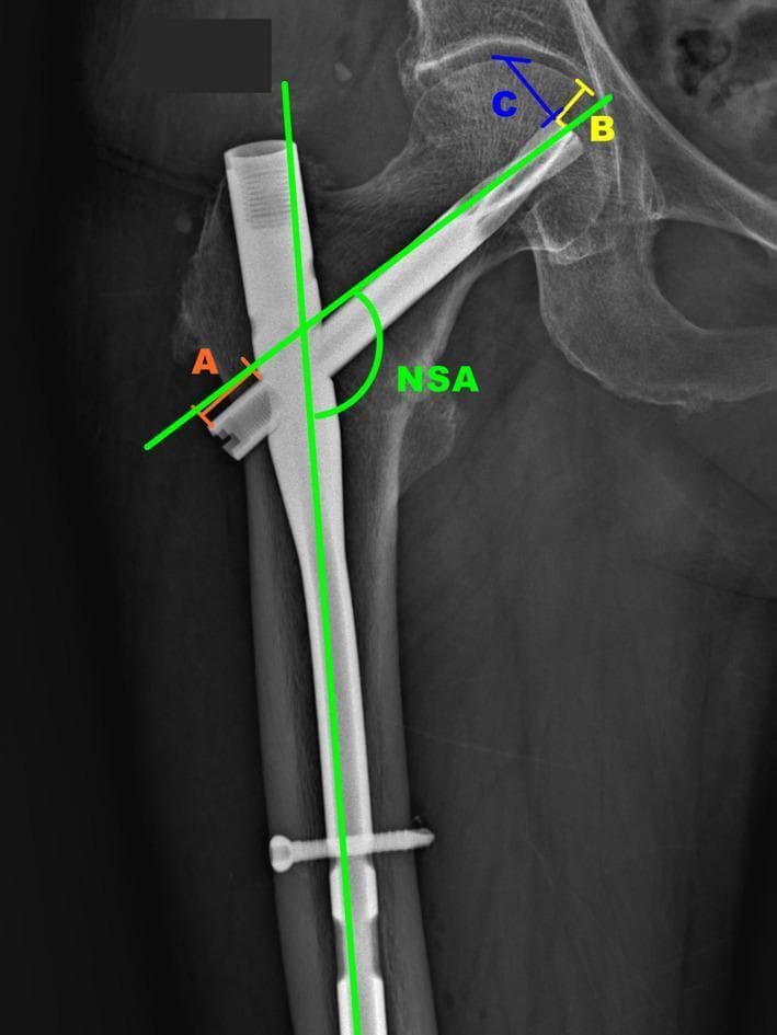 Anteroposterior (AP) X-ray of the proximal femur demonstrating an intramedullary nail fixation for an intertrochanteric fracture. The diagnostic image shows a cephalomedullary nail positioned within the femoral canal, secured by a proximal helical blade extending into the femoral head and a distal transverse locking screw. Annotated green lines indicate the Neck-Shaft Angle (NSA), measuring the alignment between the femoral shaft and neck axes. Specific geometric measurements are labeled for post-operative monitoring: Line A measures the distance from the helical blade's distal end to the nail's lateral cortex to monitor blade backout; Line B (yellow) measures distance to the medial cortex to assess femoral neck shortening or cut-through; and Line C (blue) measures distance to the superior cortex to evaluate for superior cutout. This radiograph illustrates key orthopedic parameters used to evaluate the mechanical stability and potential complications of proximal femoral internal fixation during clinical follow-up.