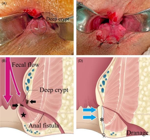 A composite image consisting of clinical photographs and pathophysiology diagrams illustrating the anatomical changes during anal fistula surgery. Panel A shows a preoperative clinical photograph of the anal canal with a 'deep crypt' circled, appearing as a cave-like invagination. Panel B is a corresponding cross-sectional diagram showing how inflammatory fibrosis (indicated by black arrows) and a hardened internal sphincter (star) create a receptacle for fecal flow, leading into an anal fistula tract. Panel C presents the postoperative clinical view using an anal speculum, demonstrating the resolution of the deep crypt. Panel D provides a postoperative diagram illustrating the surgical effect: dissection of the fistula and fibrous tissue (asterisk) and internal sphincterotomy result in the flattening of the anal canal (blue arrows) and establishment of a drainage pathway. This set demonstrates the 'Surgical Incision of Fistula Tract and Internal Sphincterotomy' (SIFT-IS) technique, focusing on eradicating the deep crypt to prevent persistent fecal entry and chronic inflammation in transsphincteric fistulas.