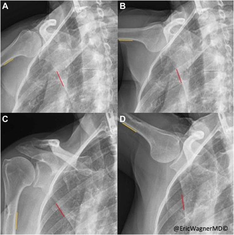 This composite diagnostic image features four clips from dynamic digital radiography (DDR) of the right shoulder, illustrating scapulohumeral rhythm (SHR). Images A and B show preoperative states at minimal and maximal humeral abduction, while C and D show the same intervals postoperatively. The images demonstrate the relationship between the humerus, scapula, and thorax. Yellow lines annotate the humerothoracic angle, while red lines represent the scapulothoracic angle measurement zones. In the preoperative sequence (A-B), there is significant humeral abduction but minimal change in the scapulothoracic angle, indicative of serratus anterior palsy and dysfunctional kinematics. In the postoperative sequence (C-D), following a pectoralis major transfer, there is a visible increase in scapular rotation accompanying humeral abduction. This visual comparison highlights the restoration of coordinated scapular movement and a normalized scapulohumeral rhythm. Key anatomical landmarks include the humeral head, glenoid cavity, coracoid process, and rib cage.