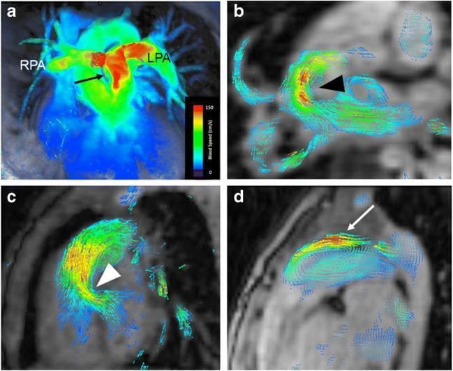 This diagnostic imaging panel demonstrates 4-D flow MRI visualizations in pediatric cardiovascular cases, utilizing color-coded velocity maps and vector fields to illustrate hemodynamic patterns. Image (a) is a coronal velocity map showing accelerated, high-velocity flow (red) in the main pulmonary artery, right pulmonary artery (RPA), and left pulmonary artery (LPA) consistent with pulmonary valve stenosis. Images (b) and (c) utilize axial and sagittal vector fields respectively to visualize shunt flow through septal defects; (b) highlights an atrial septal defect (ASD) with swirling vectors, and (c) shows a ventricular septal defect (VSD). Image (d) provides a sagittal view of a patent ductus arteriosus (PDA), demonstrating abnormal reverse and accelerated flow in the pulmonary artery represented by high-velocity color-coded vectors. The visualizations use a color scale ranging from blue (slow flow) to red (high velocity, up to 150 cm/s), facilitating the identification of stenosis, shunts, and turbulent flow patterns in congenital heart disease.