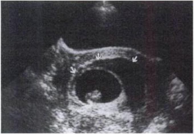 This diagnostic image is an obstetric ultrasound displaying a first-trimester pregnancy, approximately at 8 weeks of gestation. The central feature is a well-defined, oval gestational sac containing a dark, anechoic fluid space and a small, echogenic embryo. A significant pathological finding is highlighted by three white arrows: a large subchorionic hematoma. This hematoma appears as a crescent-shaped, hypoechoic to sonolucent area situated between the gestational sac (chorionic membrane) and the uterine myometrium. Visually, the collection of blood is extensive, encompassing at least two-thirds of the gestational sac's circumference. This image serves as a clinical example of an intrauterine hemorrhage, specifically the subchorionic type, which is a common cause of first-trimester vaginal bleeding. The educational focus is on identifying the echogenicity and anatomical location of subchorionic fluid collections relative to the placental membranes and assessing their size in proportion to the chorionic sac for clinical risk stratification.