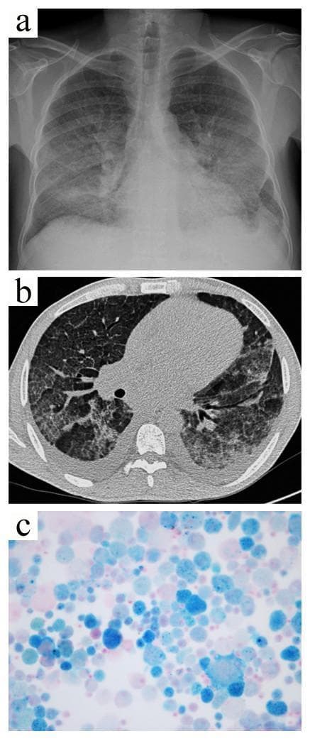This composite medical image illustrates a case of Diffuse Alveolar Hemorrhage (DAH) secondary to cryoglobulinemic vasculitis through multimodality imaging and pathology.