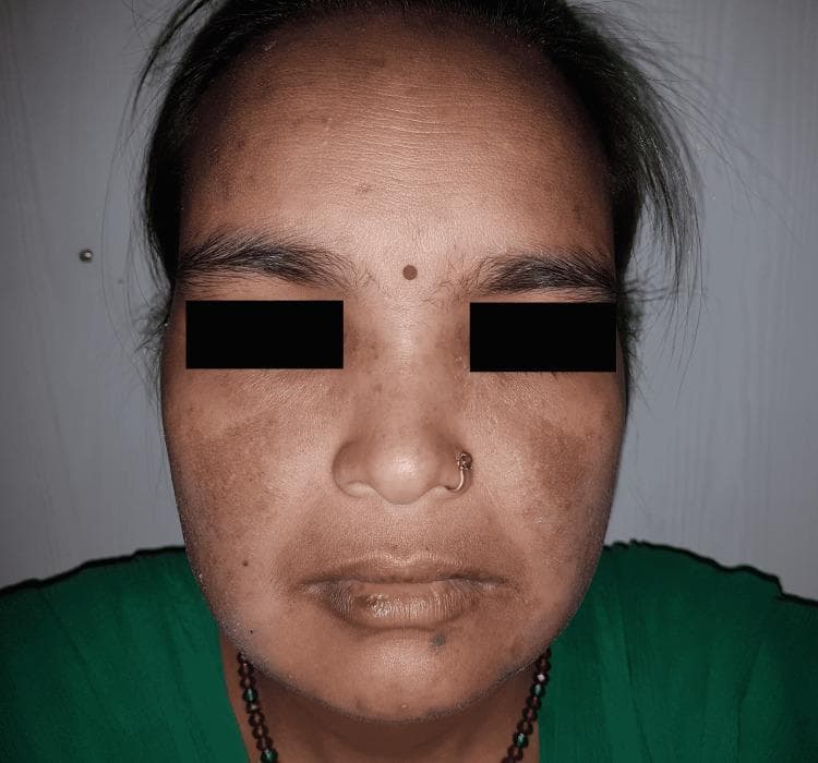 This clinical photograph of a 38-year-old female patient displays a classic malar rash (butterfly rash), a hallmark sign of Systemic Lupus Erythematosus (SLE). The image illustrates a symmetric, erythematous maculopapular eruption extending across the nasal bridge and both malar eminences (cheeks). A key diagnostic feature visible is the distinct sparing of the nasolabial folds. The affected skin shows reddish discoloration with both flat (macular) and slightly raised (papular) textures. Additional observations include generalized facial hyperpigmentation, uneven skin tone on the forehead, and mild dryness or discoloration at the vermillion border of the lips. The photograph serves as a primary educational resource for medical students and clinicians to recognize LE-specific cutaneous manifestations. The target audience is intermediate-level medical learners focusing on rheumatology and dermatology. Educational concepts highlighted include the distribution patterns of photosensitive rashes and the clinical distinction between lupus-related malar eruptions and other facial dermatoses like rosacea, which typically involves the nasolabial folds.