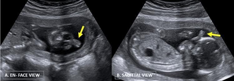 Two B-mode grayscale two-dimensional antenatal ultrasound images demonstrate fetal facial anomalies in a fetus at approximately 16 weeks gestation. (A) The 'en face' view shows a cross-sectional representation of the fetal face with visible orbits and a prominent midline soft tissue projection. (B) The 'sagittal' view provides a side profile clearly illustrating the forehead, nasal region, and oral cavity, with a distinct tubular or cylindrical structure extending outwards from the midline of the forehead. This structure, marked by yellow arrows in both views, is a proboscis, a hallmark facial dysmorphism often associated with holoprosencephaly spectrum disorders such as ethmocephaly or cyclopia. These images are critical for the prenatal diagnosis of midline craniofacial defects and the assessment of associated central nervous system malformations.