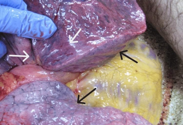 This forensic clinical photograph depicts the gross pathological findings of the lungs during an internal examination (autopsy). The lung tissue demonstrates severe pulmonary congestion, characterized by a diffuse, dark reddish-purple discoloration and a heavy, engorged appearance. Labeled with black arrows are areas of pulmonary edema, manifesting as localized swelling and a glistening, fluid-filled texture on the pleural surface. Indicated by white arrows are multiple petechial hemorrhages (Tardieu spots), appearing as small, pinpoint red subpleural spots. These findings are classic markers of mechanical asphyxia. The image also shows adjacent mediastinal structures, including epicardial fat on the heart surface. The photograph is taken in situ with a gloved hand providing retraction to expose the diaphragmatic and costal surfaces of the lung lobes. This visual is intended for forensic pathology and medical education to illustrate the non-specific signs of rapid death due to hypoxia or asphyxiation.