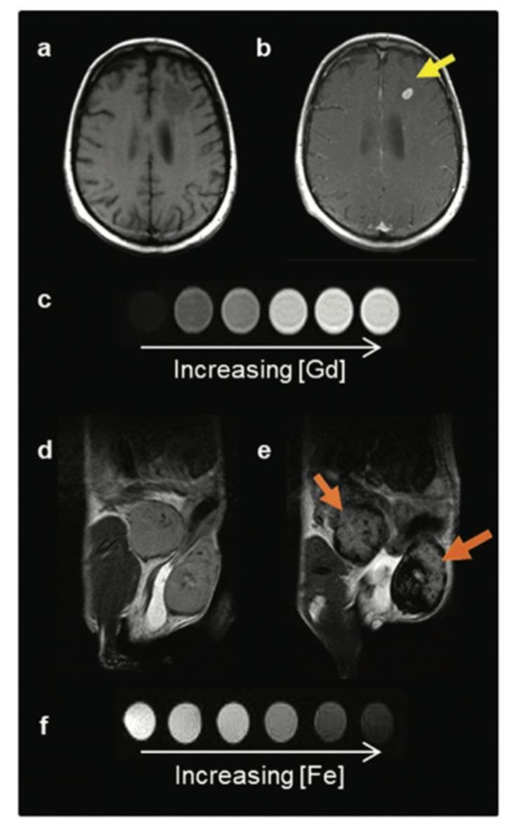This educational comparison chart illustrates the mechanisms and visual outcomes of two primary classes of MRI contrast agents. The top section displays axial T1-weighted MRI scans of a human brain before (a) and after (b) the administration of a Gadolinium-Based Contrast Agent (GBCA). A yellow arrow highlights a hyperintense (bright) metastatic lesion, demonstrating how T1 agents shorten spin-lattice relaxation time to increase signal. Below this, a series of phantoms (c) shows that as Gadolinium concentration increases, signal intensity progressively brightens. The bottom section presents T2-weighted MRI scans of a murine model before (d) and after (e) the administration of Iron Oxide Nanoparticle (IONP) contrast agents. Orange arrows point to hypointense (dark) areas in mammary gland tumors, illustrating how T2 agents shorten spin-spin relaxation time to induce signal loss. The corresponding phantoms (f) confirm that increasing iron concentration leads to a darker, hypointense signal. The graphic serves to distinguish between T1 'positive' contrast and T2 'negative' contrast in diagnostic radiology.