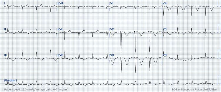 This diagnostic image is a 12-lead electrocardiogram (ECG) demonstrating several clinically significant abnormalities. Key findings include deep, symmetrical, and biphasic T-wave inversions primarily across the precordial leads V2 to V5, with the most pronounced inversion occurring in V3. Similar, though less severe, T-wave inversions are also noted in the inferior limb leads (II, III, and aVF). The tracing exhibits poor R-wave progression across the precordial leads, characterized by the failure of the R-wave amplitude to increase appropriately from V1 through V6. Additionally, there is evidence of right axis deviation. These visual features are often associated with right ventricular strain, as seen in clinical contexts such as acute pulmonary embolism or the Zurkurnai ECG pattern. The ECG is recorded at a standard paper speed of 25.0 mm/s and a voltage gain of 10.0 mm/mV, showing a sinus rhythm. This educational resource illustrates key ECG markers used in the identification of pulmonary hypertension and acute right heart strain.