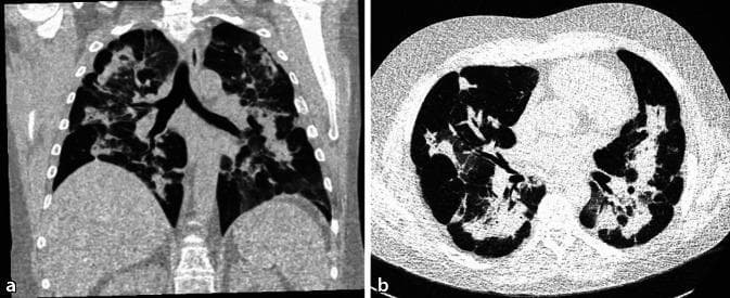 This diagnostic imaging set consists of two non-contrast CT scans of the chest: a coronal reconstruction (a) and a transverse/axial slice (b). The images demonstrate extensive, symmetrical, bilateral lung abnormalities characterized by mixed ground-glass opacities and areas of consolidation. A hallmark feature of the distribution is the predominant involvement of the central, peribronchovascular zones with notable subpleural sparing, where the peripheral lung parenchyma adjacent to the pleura remains clear. There is also evidence of bronchial wall thickening. These findings are consistent with diffuse parenchymal lung disease processes, such as cryptogenic organizing pneumonia (COP) or eosinophilic pneumonia, characterized by peribronchovascular infiltrates. The image serves as an educational example of central lung consolidation patterns and the significance of subpleural sparing in narrowing differential diagnoses for interstitial or inflammatory lung diseases.