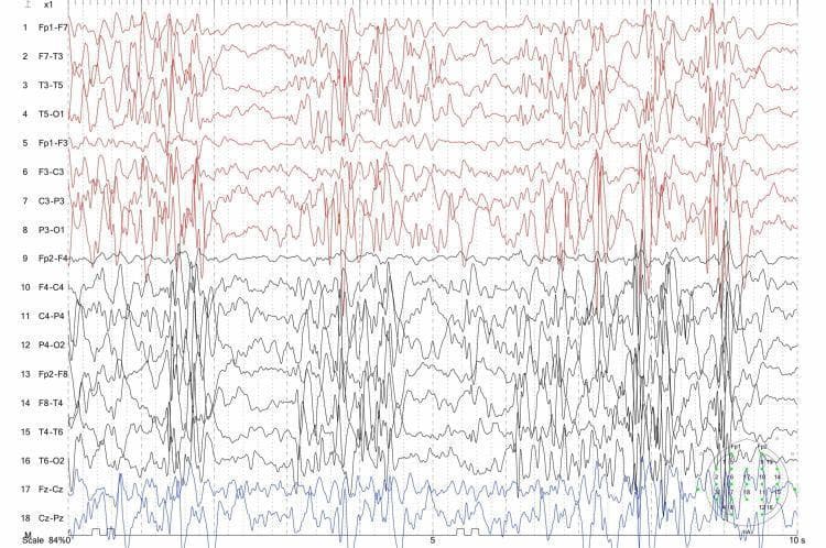 This diagnostic image displays a multi-channel electroencephalogram (EEG) recording demonstrating classic hypsarrhythmia, the hallmark finding of West syndrome (infantile spasms). The EEG trace shows a highly disorganized, chaotic, and non-rhythmic background pattern. Key features include high-amplitude slow waves interspersed with frequent, multifocal, independent spikes and sharp-wave discharges. The recording is divided into 18 channels using a standard montage (e.g., Fp1-F7, Fp2-F4, Fz-Cz). Channels 1 through 16 (colored red and black) exhibit the most pronounced high-voltage, irregular activity and spike-wave complexes. Channels 17 and 18 (blue) represent midline electrodes (Fz-Cz and Cz-Pz), showing a relative difference in amplitude but contributing to the overall pattern of chaotic cortical dysfunction. This pattern represents the interictal state of an infant with spasms before the initiation of treatment, such as ACTH or Vitamin B12, and is essential for the diagnosis of epileptic encephalopathy in the pediatric population.